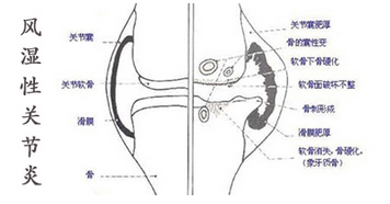 风湿性关节炎